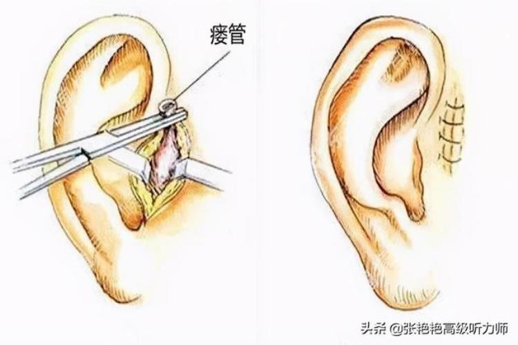 拴马桩耳真的有福气吗,哪些耳相天生好运,耳仓真的代表福气吗