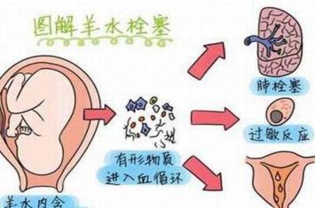 羊水栓塞是什么?羊水栓塞主要原因是什么(80%死亡率)