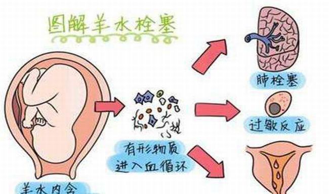 什么人易得羊水栓塞?这六种孕妇一定要注意(极度凶险)