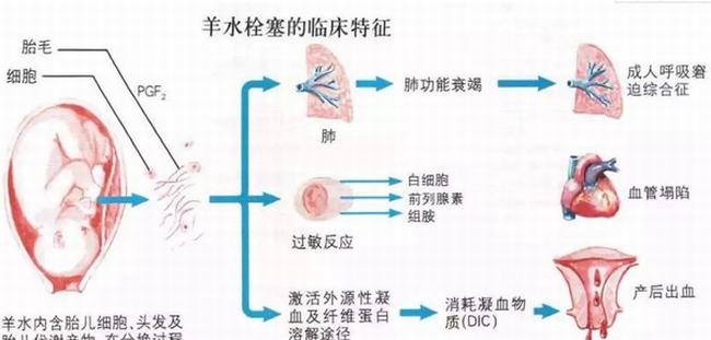 什么人易得羊水栓塞?这六种孕妇一定要注意(极度凶险)