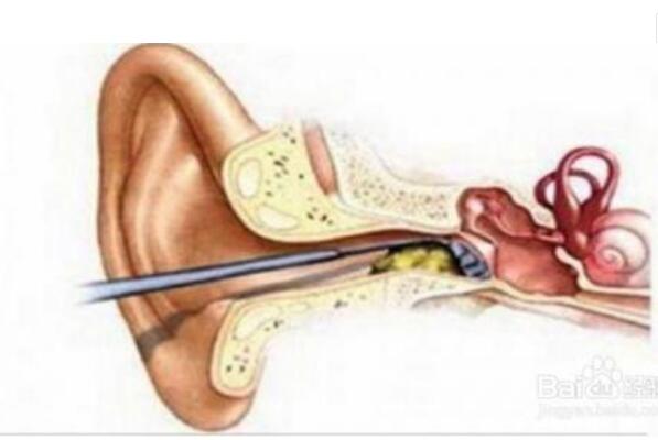耳屎的作用 能够有效保护外耳道的健康防止细菌滋生