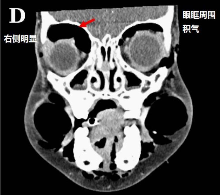 男孩全身多处气肿竟是阿莫西林惹的祸