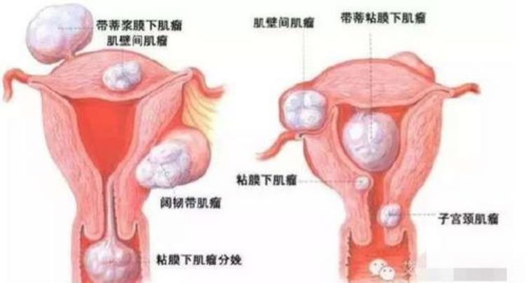 宫颈癌产生原因主要与以下哪个病毒有关,宫颈癌的诱发因素