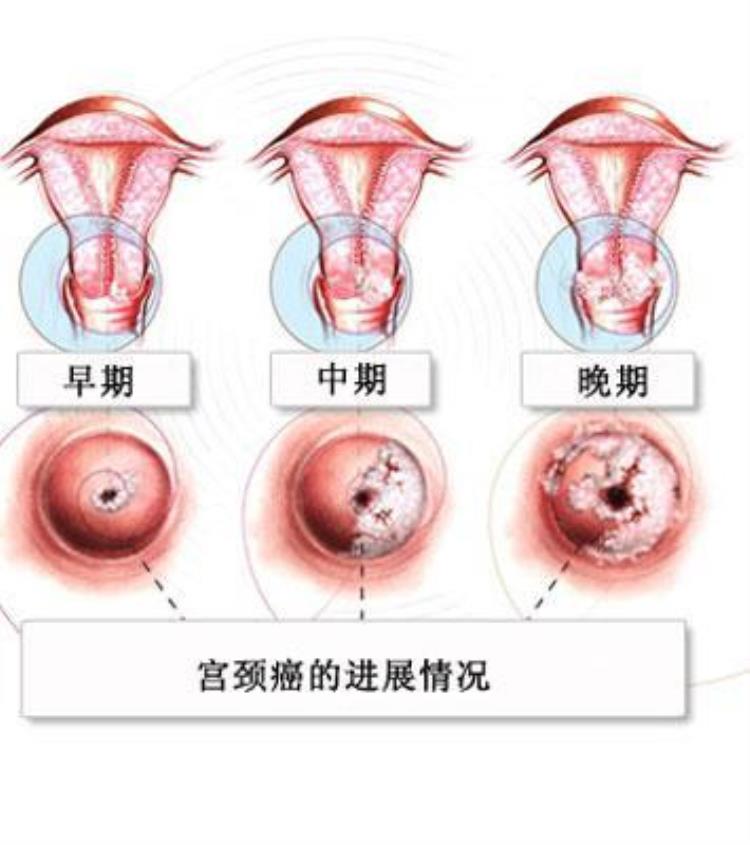 hpv是如何引发癌症的,hpv病毒引起的癌症有哪些