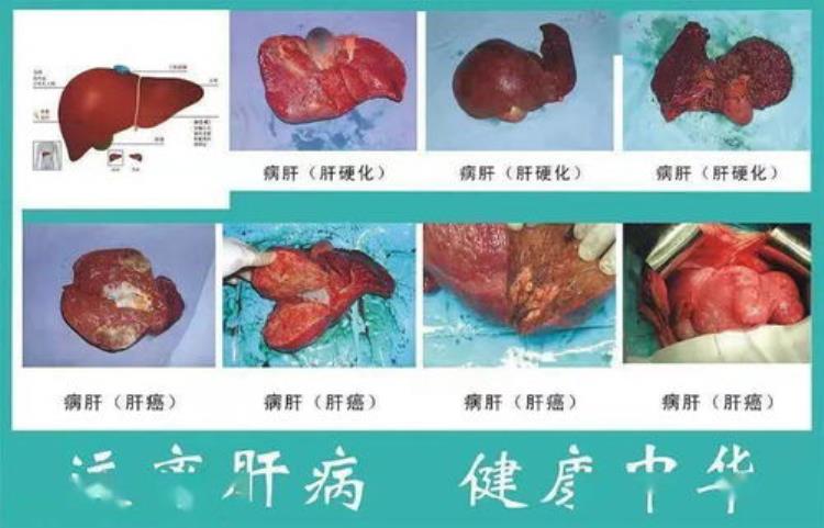 病毒是怎样侵害肝脏的呢,乙肝病毒会侵害肝脏吗