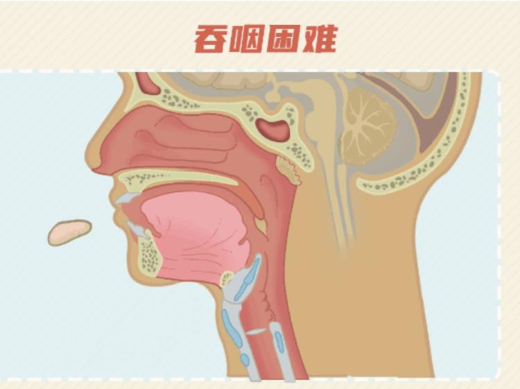 脑梗塞的患者为什么会出现呛咳,脑出血喝水为什么呛咳