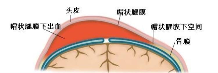 纠头发使头皮与头骨分离,老师揪孩子头发致皮骨分离