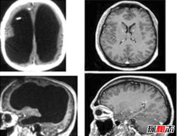 永生人叶先国真的存在？没脑组织能活吗（实际是小说节选）