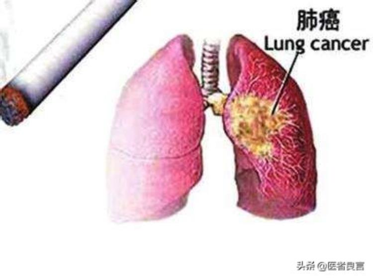 肺癌死亡的过程,肺癌最后死亡的征兆